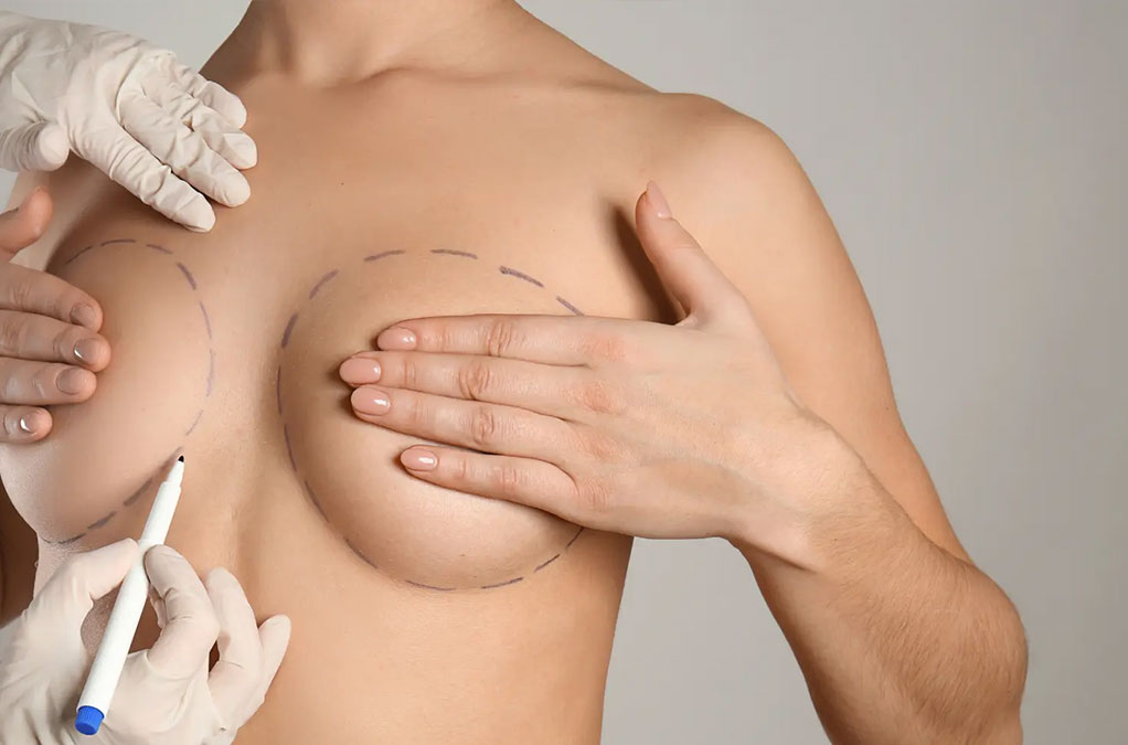 Mamoplastia Redutora e Mastopexia (Levantamento da mama) - Clínica Dr  Claudio Dias